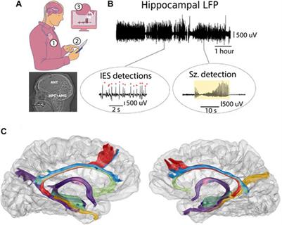 Case report: Bridging limbic network epilepsy with psychiatric, memory, and sleep comorbidities: case illustrations of reversible psychosis symptoms during continuous, high-frequency ANT-DBS